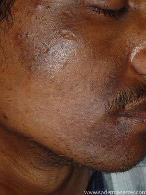 PIH-Before